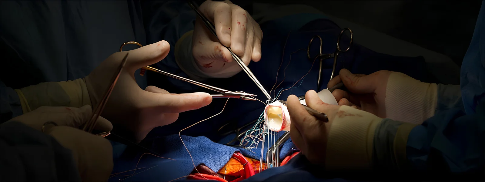 Cardiothoracic And Vascular Surgery (CTVS)